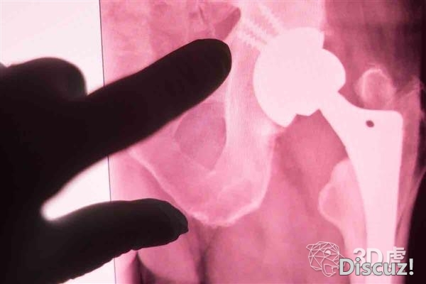 悉尼大学研究员开发出与天然骨融合的3D打印陶瓷植入物